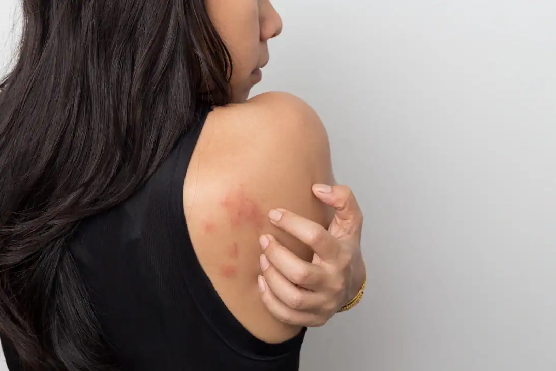 woman with symptoms who may qualify for a chronic hives research study