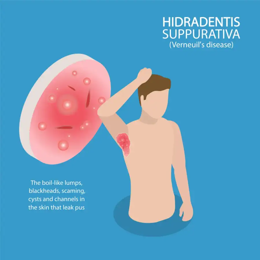 symptoms: hidradenitis suppurativa clinical study