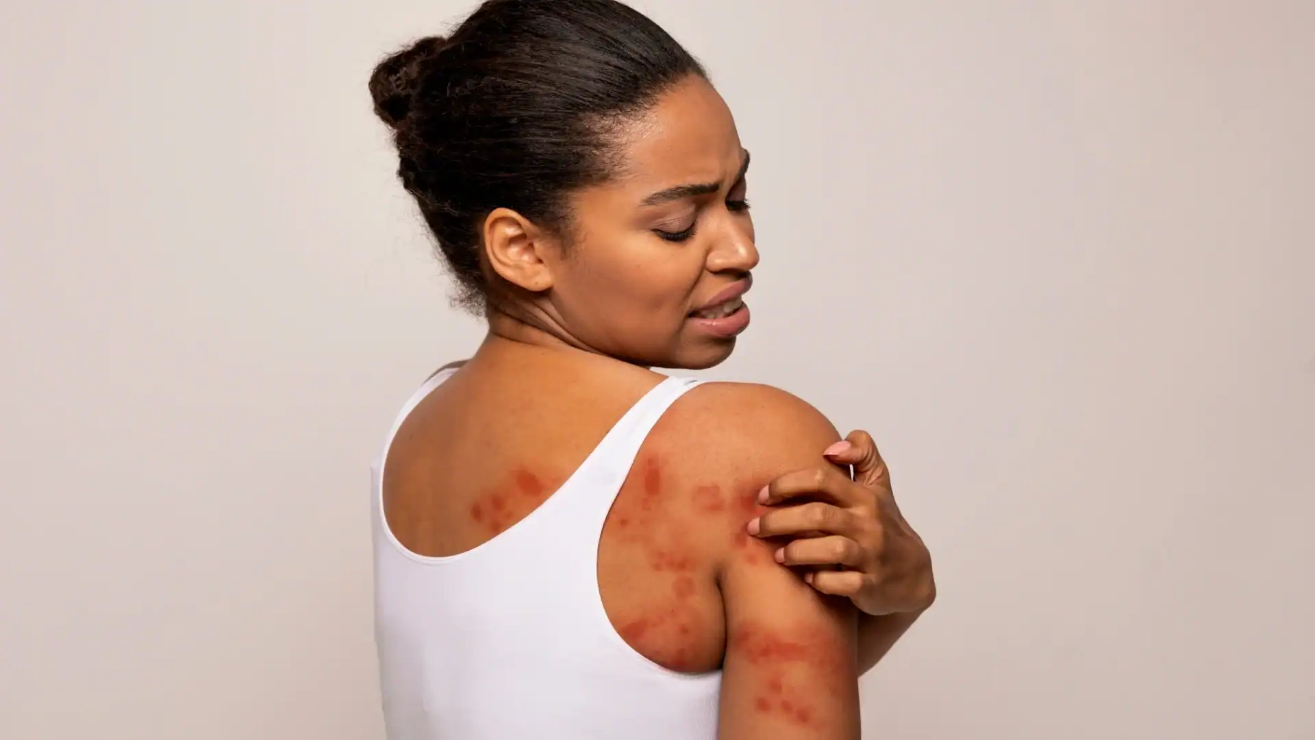 prurigo nodularis research study participant