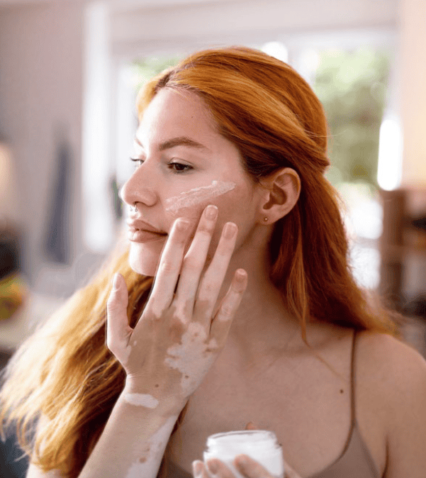 a woman with skin condition that may qualify for a vitiligo research study
